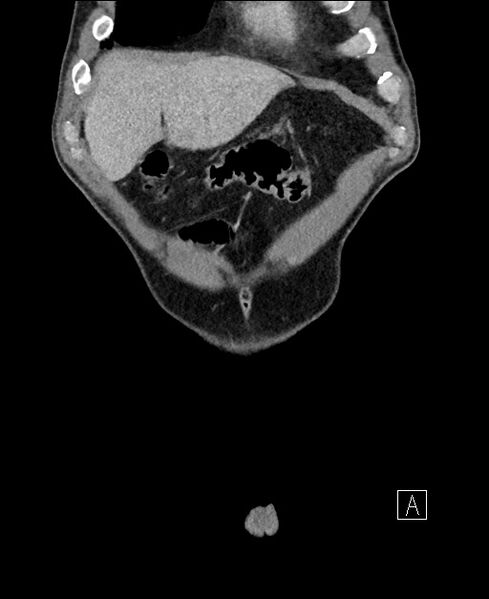 File:Closed loop small bowel obstruction - internal hernia (Radiopaedia 57806-64778 A 14).jpg