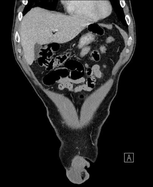File:Closed loop small bowel obstruction - internal hernia (Radiopaedia 57806-64778 A 23).jpg
