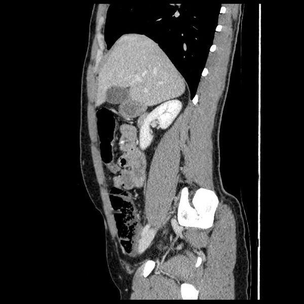 File:Co-existing acute appendicitis and epiploic appendagitis (Radiopaedia 61789-69911 B 31).jpg