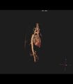 Coarctation of the aorta (Radiopaedia 43373-46729 3D reconstruction 34).jpg