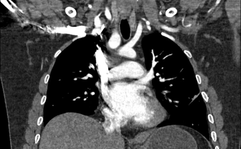 File:Coarctation of the aorta (Radiopaedia 53363-59343 C 32).jpg