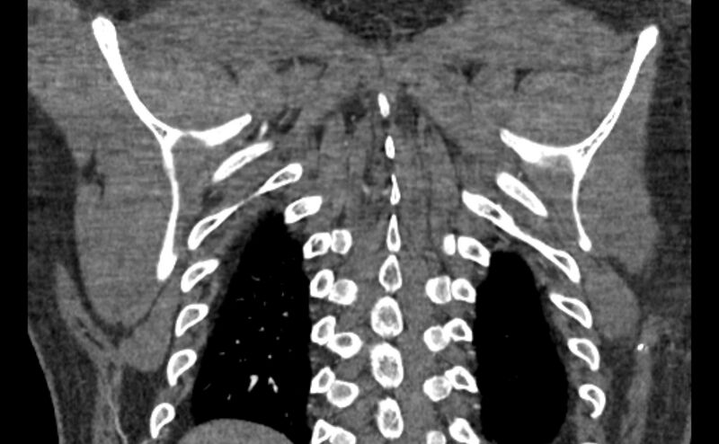 File:Coarctation of the aorta (Radiopaedia 53363-59343 C 62).jpg