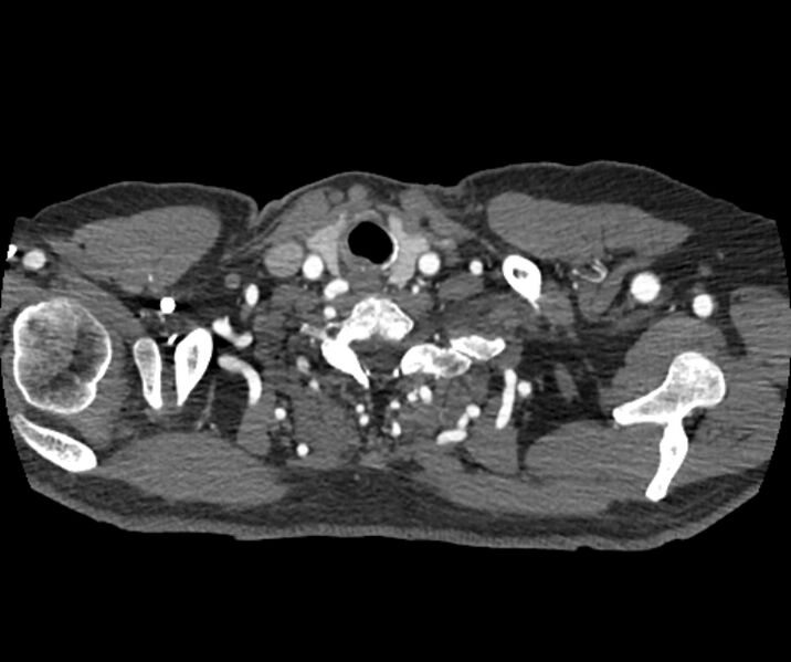 File:Coarctation of the aorta (Radiopaedia 53752-59822 A 12).jpg