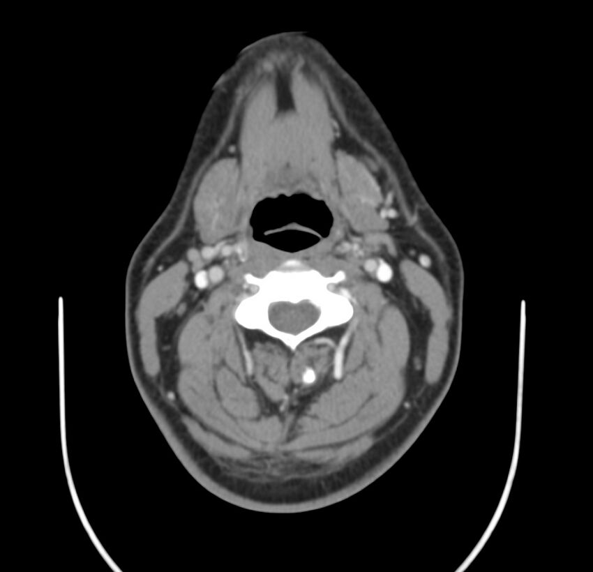 Colloid cyst of thyroid (Radiopaedia 22897-22923 Axial C+ delayed 35).jpg