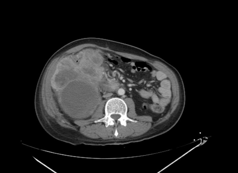 File:Colon cancer mimicking renal cell carcinoma (Radiopaedia 28986-29335 C 39).jpg