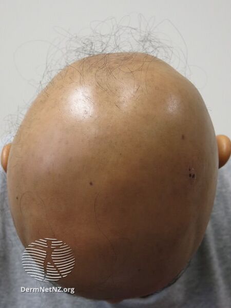File:Diffuse hair loss due to alopecia totalis (DermNet NZ diffuse-alopecia-01).jpg