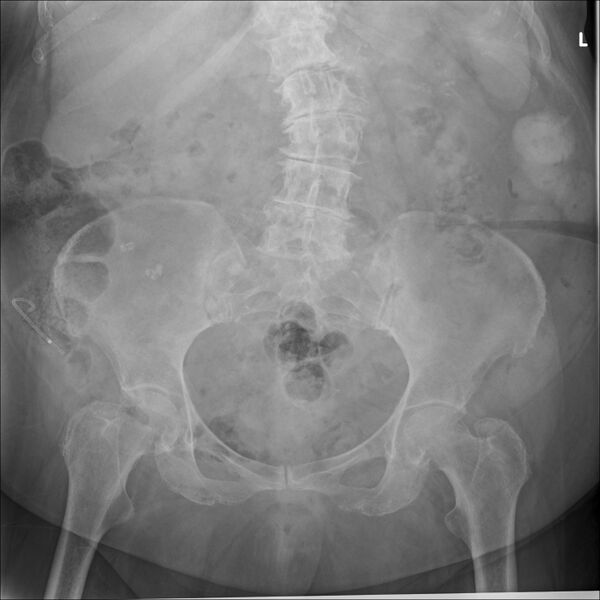File:Migrated pancreatic duct stent (Radiopaedia 76177).jpg