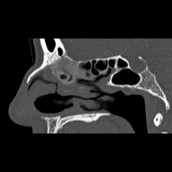 File:Nasal septal perforation (Radiopaedia 25030-25289 Sagittal bone window 25).jpg