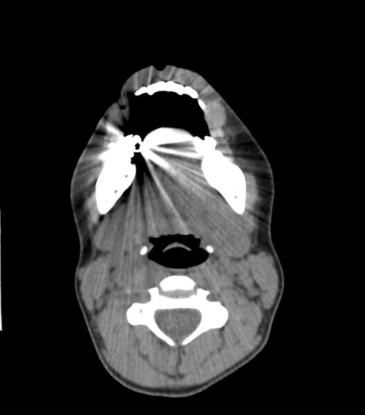 File:Nasoorbitoethmoid fracture (Radiopaedia 90044-107205 Axial 245).jpg