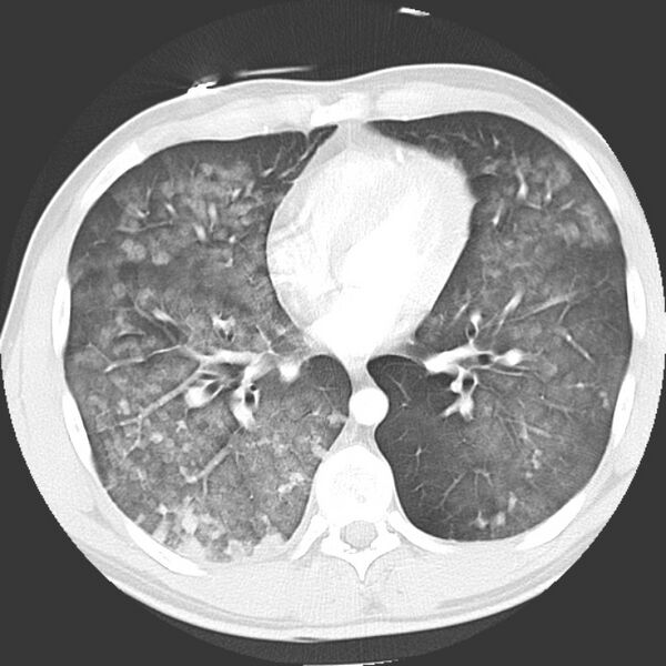 File:Near drowning pulmonary edema (Radiopaedia 16868-16591 Axial lung window 31).jpg