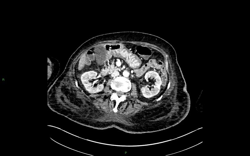 Neo-terminal ileal stricture (Crohn disease) (Radiopaedia 33790-34948 A 180).jpg