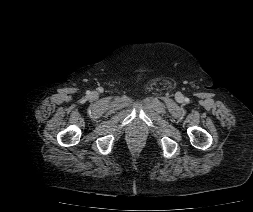 Nephroptosis with inguinal hernia containing perirenal fat (Radiopaedia 56632-63391 C 342).jpg