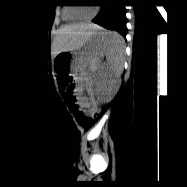File:Neuroblastoma with skull metastases (Radiopaedia 30326-30960 B 34).jpg