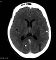 Neurocysticercosis (Radiopaedia 7773-8596 C+ delayed 9).jpg