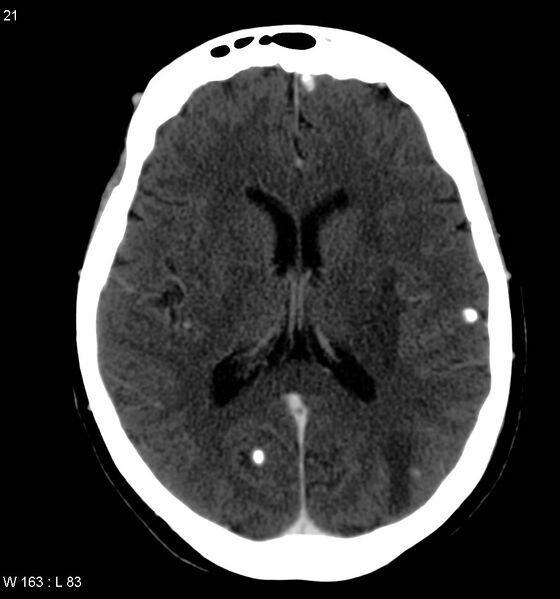 File:Neurocysticercosis (Radiopaedia 7773-8596 C+ delayed 9).jpg