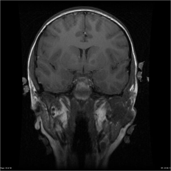 File:Neurofibromatosis type 1 (Radiopaedia 22541-22564 Coronal T1 28).jpg