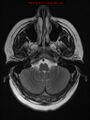 Neuroglial cyst (Radiopaedia 10713-11184 Axial T2 19).jpg