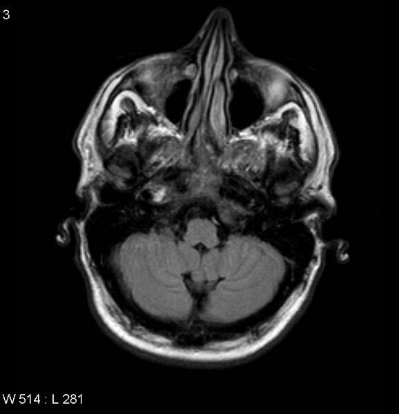 File:Neurosarcoidosis (Radiopaedia 10930-17204 Axial FLAIR 3).jpg