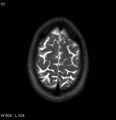 Neurosarcoidosis (Radiopaedia 10930-17204 Axial T2 18).jpg