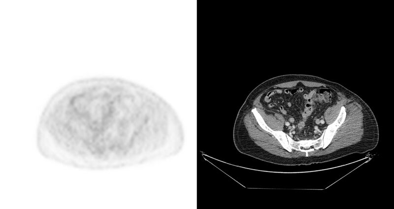 File:Non-Hodgkin lymphoma involving seminal vesicles with development of interstitial pneumonitis during Rituximab therapy (Radiopaedia 32703-33675 axial PET CT 14).jpg