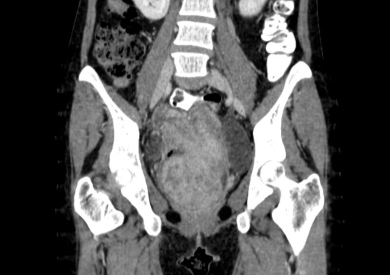 File:Non-puerperal uterine inversion (Radiopaedia 78343-91094 B 11).jpg