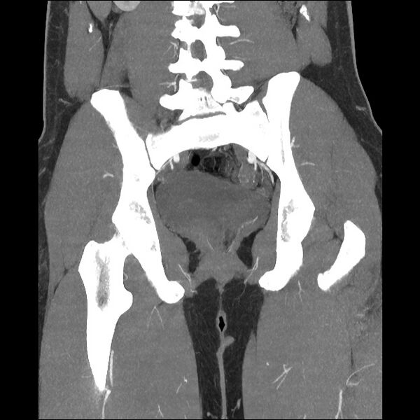 File:Normal CT angiogram of pelvis (Radiopaedia 45390-49430 B 30).jpg