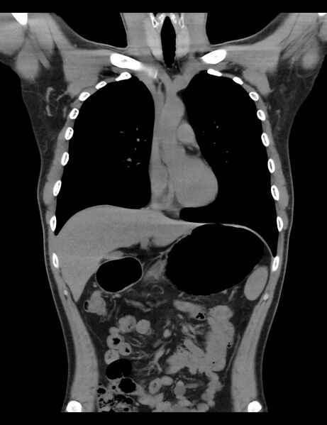 File:Normal CT virtual gastroscopy (Radiopaedia 29960-30501 E 12).jpg