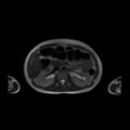 Normal MRI abdomen in pregnancy (Radiopaedia 88001-104541 Axial T2 23).jpg