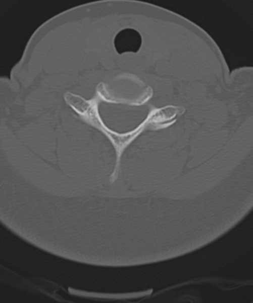 File:Normal cervical spine MRI (including Dixon) (Radiopaedia 42762-45926 Axial bone window 42).png