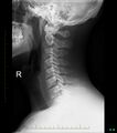 Normal cervical spine radiographs (Radiopaedia 32505-33464 Lateral 1).jpg