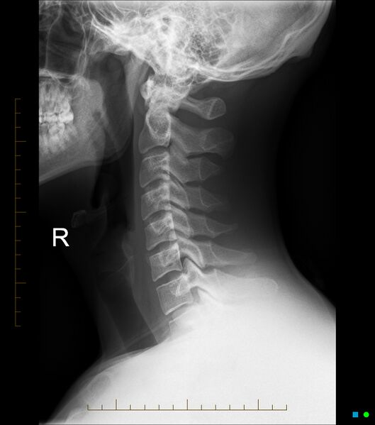 File:Normal cervical spine radiographs (Radiopaedia 32505-33464 Lateral 1).jpg