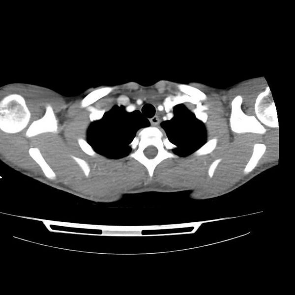 File:Normal dual-phase trauma CT chest,abdomen and pelvis (Radiopaedia 48092-52899 A 7).jpg