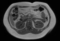 Normal liver MRI with Gadolinium (Radiopaedia 58913-66163 Axial T1 in-phase 15).jpg