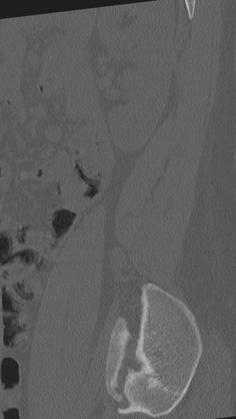 File:Normal lumbar spine CT (Radiopaedia 46533-50986 Sagittal bone window 11).png