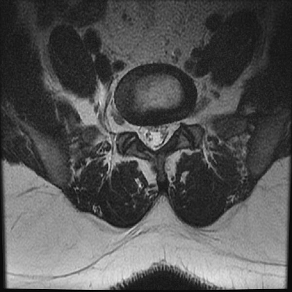 File:Normal lumbar spine MRI (Radiopaedia 43051-46311 Axial T2 23).jpg