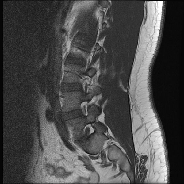 File:Normal lumbar spine MRI (Radiopaedia 43051-46311 Sagittal T1 16).jpg