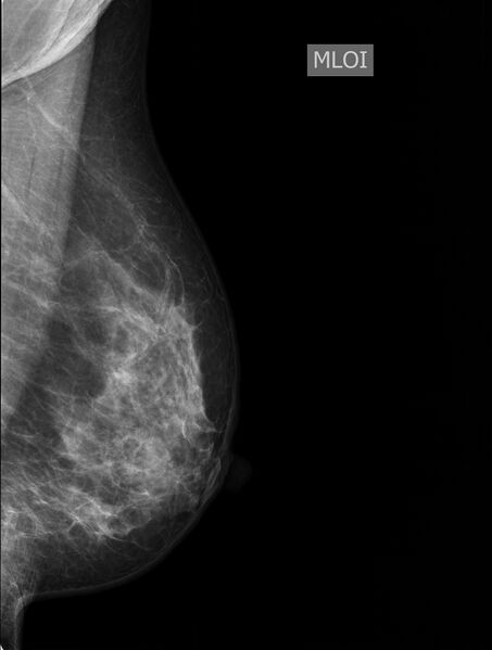 File:Normal mammogram radiographs (Radiopaedia 77107-89068 MLO 1).jpg