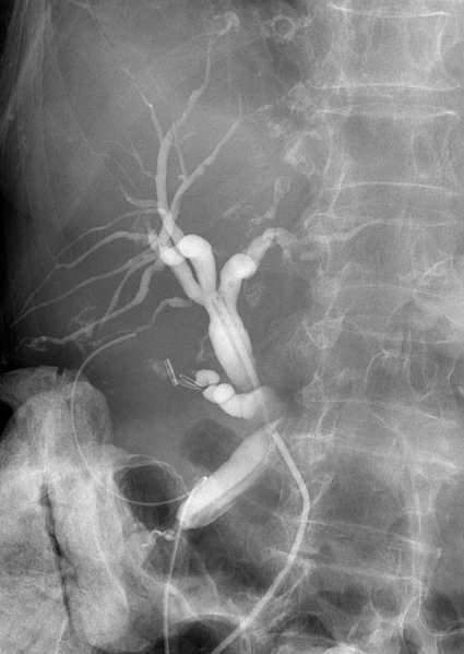 File:Normal post-cholecystectomy T-tube cholangiogram (Radiopaedia 31881).png