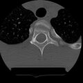 Normal trauma spine imaging (age 16) (Radiopaedia 45335-49358 Axial bone window 88).jpg