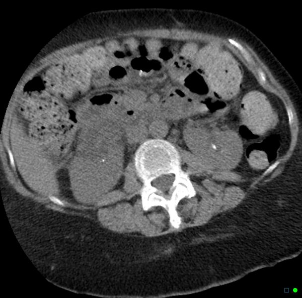 File:Obstructed infected horseshoe kidney (Radiopaedia 18116-17898 non-contrast 10).jpg
