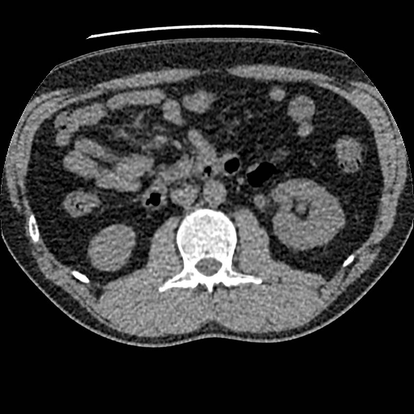 Obstructing ureteric calculus and ureteric anatomy (Radiopaedia 62730-71042 Axial non-contrast 49).jpg