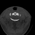 Occipital condyle fracture (Radiopaedia 31755-32691 Axial bone window 17).jpg