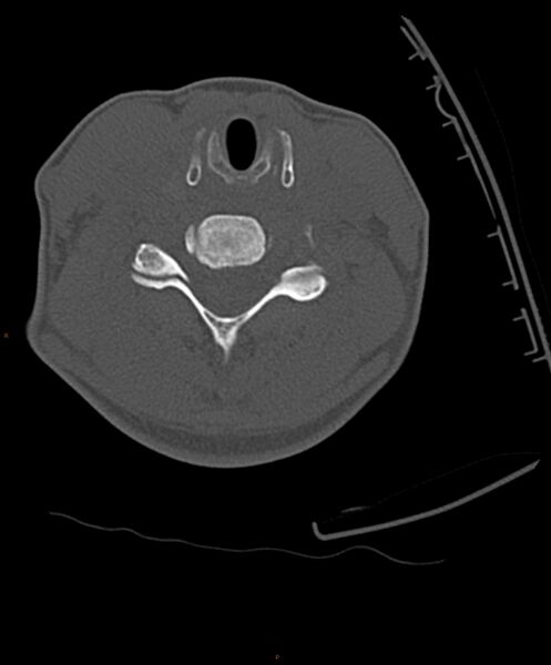 File:Occipital condyle fracture (Radiopaedia 61165-69056 D 19).jpg