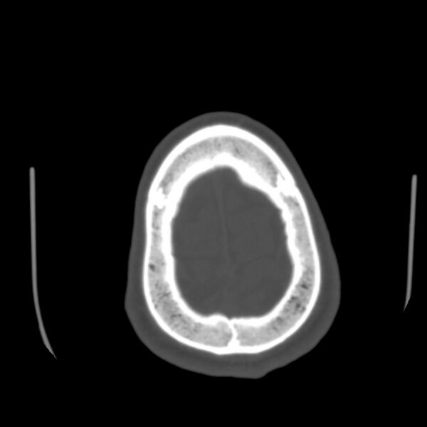 File:Occipital spur - asymptomatic (Radiopaedia 87753-104201 Axial bone window 193).jpg