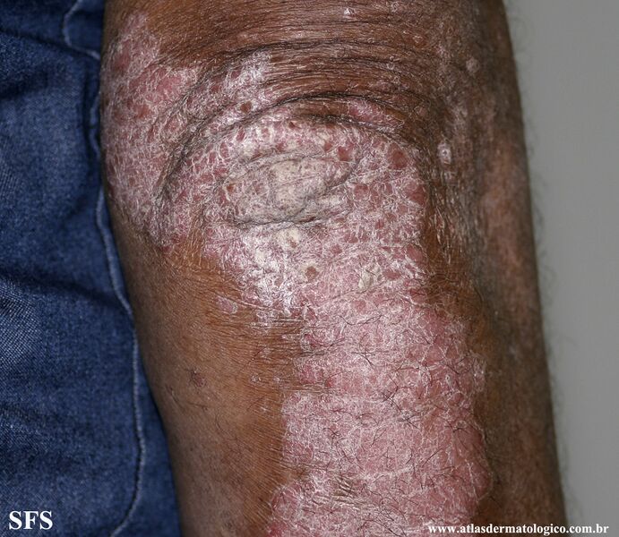File:Psoriasis (Dermatology Atlas 101).jpg