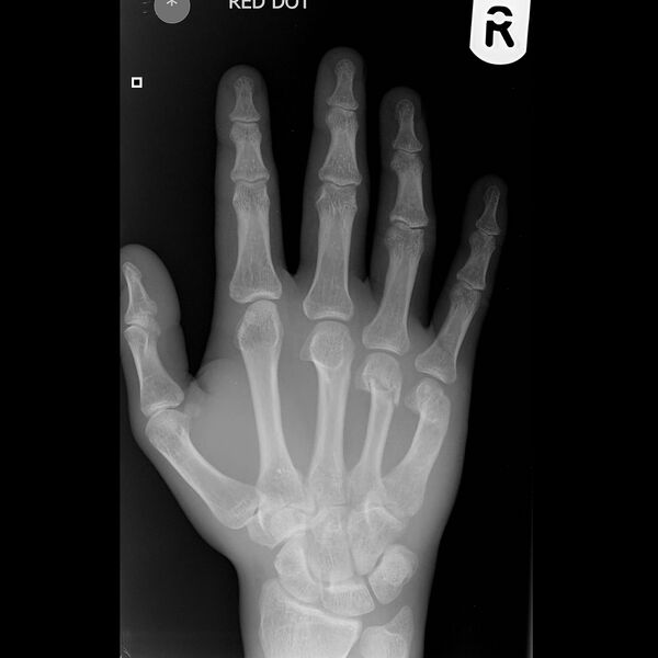 File:4th and 5th metacarpal neck fracture (Radiopaedia 7313-8222 Frontal 1).jpg