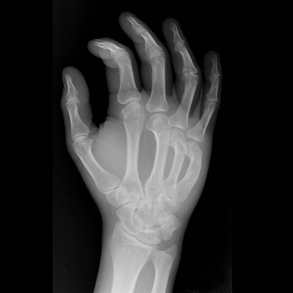 File:4th and 5th metacarpal neck fracture (Radiopaedia 7313-8222 Oblique 1).jpg
