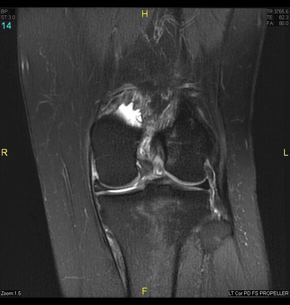File:ACL mucoid degeration with cystic changes (Radiopaedia 48428-53341 Coronal PD fat sat 11).jpg