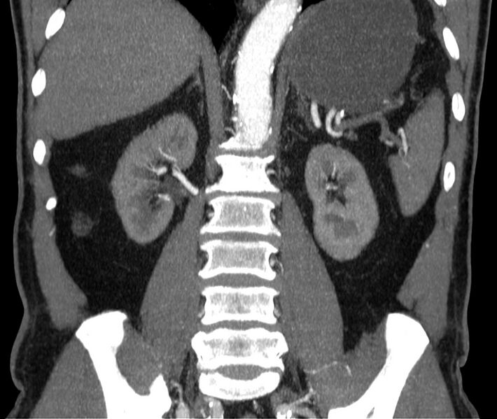 File:Abdominal aortic aneurysm (Radiopaedia 22421-22458 C 29).jpg