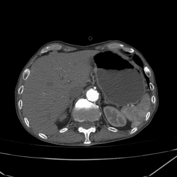 File:Abdominal aortic aneurysm (Radiopaedia 23703-23856 Axial C+ arterial phase 11).jpg